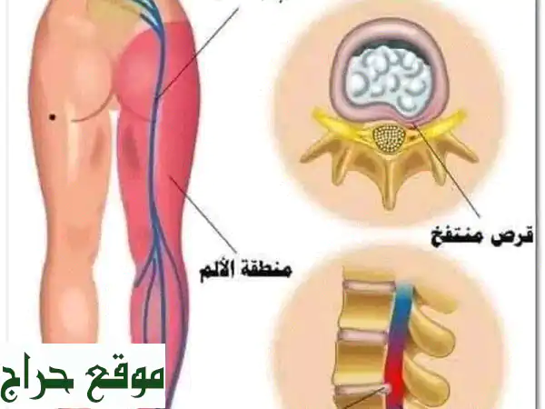 هل تعاني من آلام عرق النسا المزمن هل تعاني من...