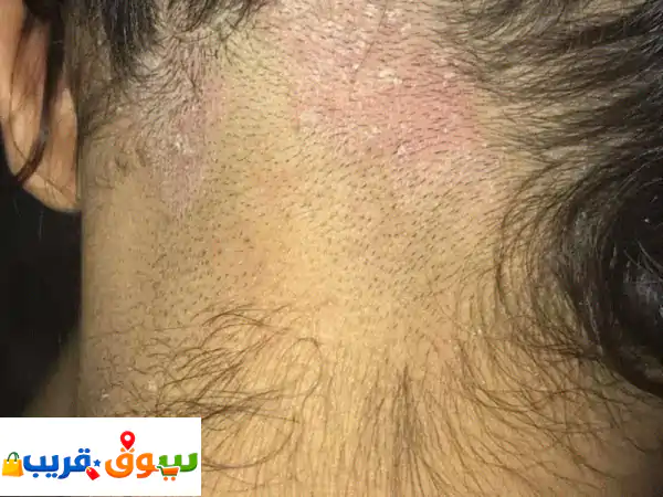 وداعاً لتساقط الشعر والقشرة! اكتشفي سر شعر صحي...